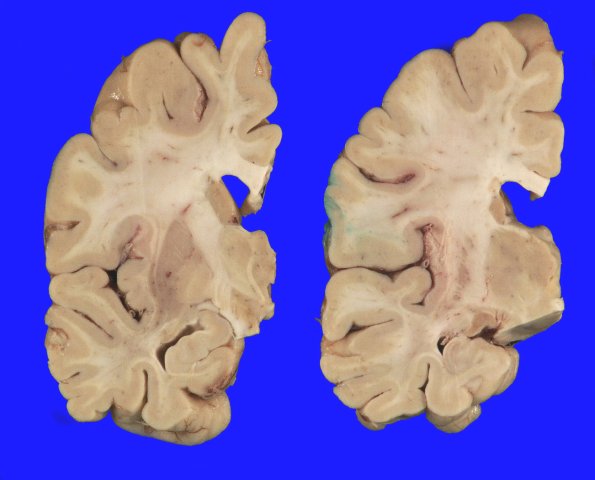 10A3 DLBD (Case 10) _4