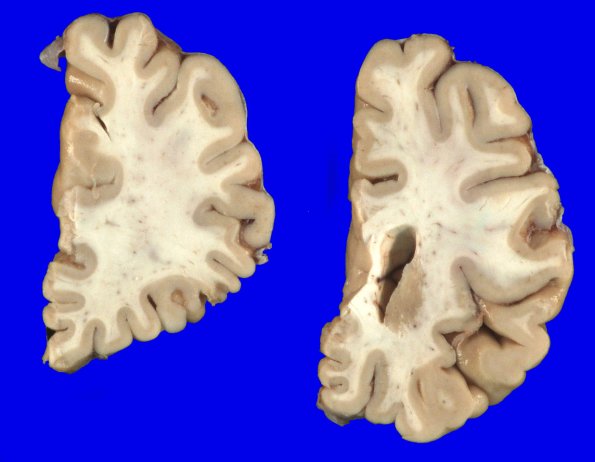 1A3 PD & DLBD (PD first, no AD) (Case 1) Gross_11