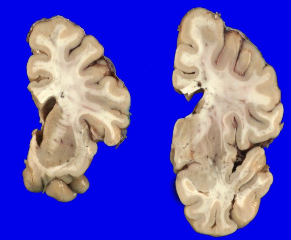 1A4 PD & DLBD (PD first, no AD) (Case 1) Gross_12