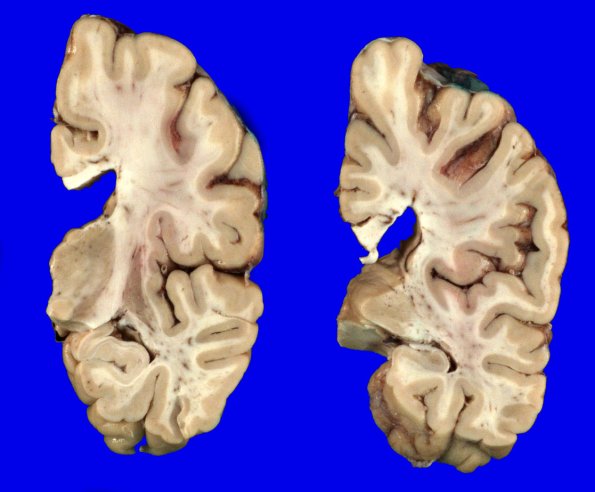 1A5 PD & DLBD (PD first, no AD) (Case 1) Gross_13