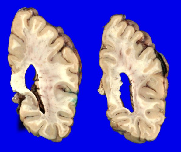 1A6 PD & DLBD (PD first, no AD) (Case 1) Gross_14