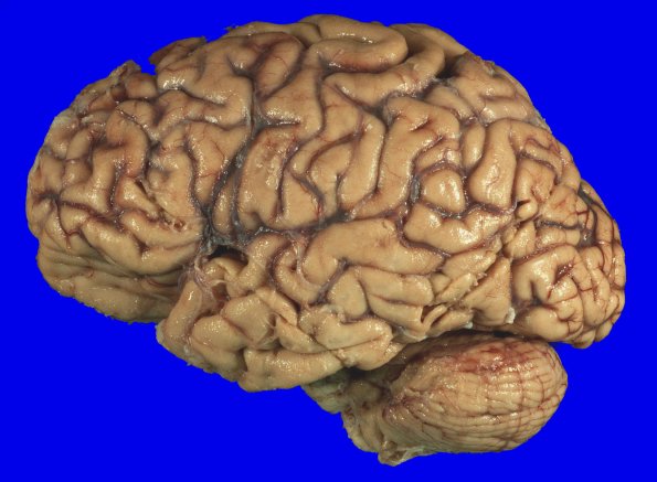 3A1 Limbic DLBD & Hippocampal sclerosis (Case 3) _3