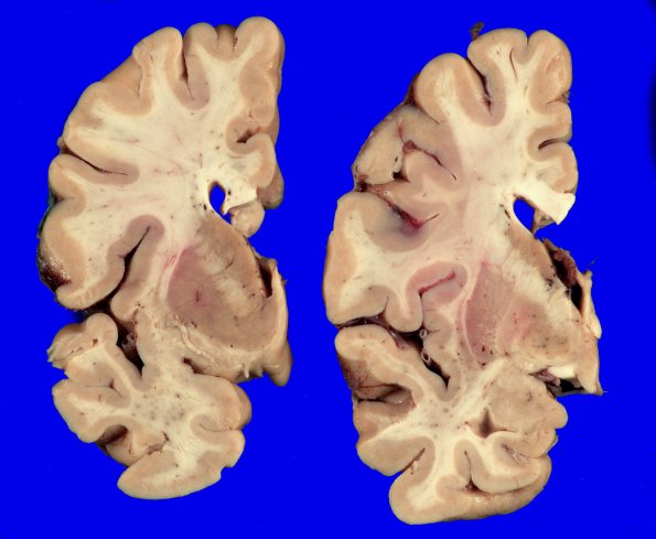 3A2 Limbic DLBD & Hippocampal sclerosis (Case 3) _6