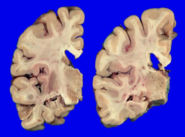 3A3 Limbic DLBD & Hippocampal sclerosis (Case 3) _7