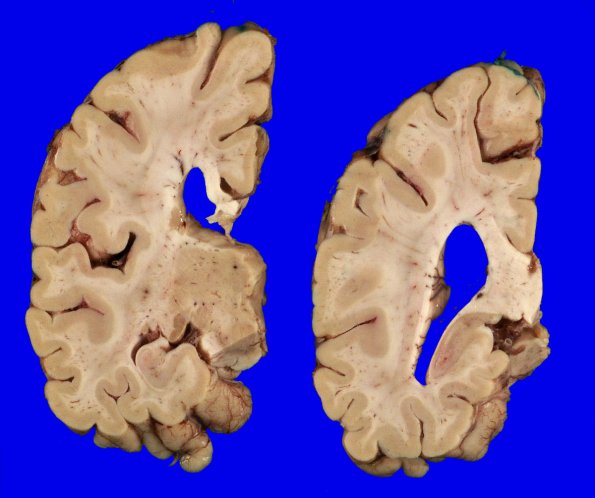 8A3 DLBD (Case 8) _4