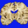 1A1 Parkinson's Dz (Case 1) Pallidotomy & Subthal stim gross 1