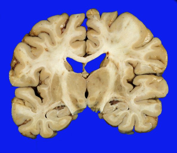 1A1 Parkinson's Dz (Case 1) Pallidotomy & Subthal stim gross 1