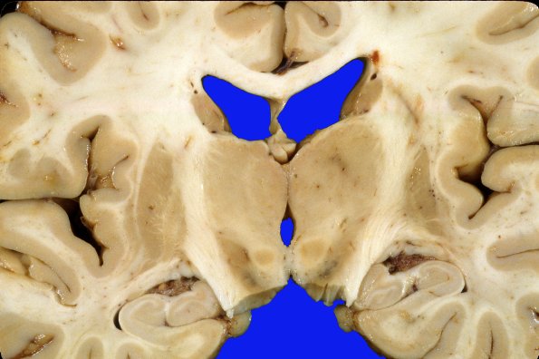 1A2 PD, Pallidotomy, subthalamic stimulators (Case 1) 2