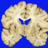 1A4 Parkinson's Dz (Case 1) Pallidotomy & STN Gross 2