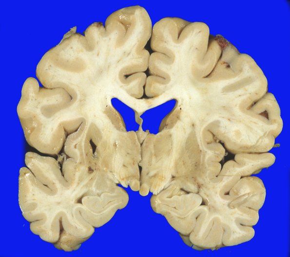 1A4 Parkinson's Dz (Case 1) Pallidotomy & STN Gross 2