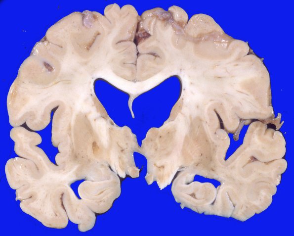 2A1 Parkinson Dz Pallidotomy (Case 2) 1