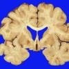 3A1 Parkinson's Dz (Case 3) Pallidotomy 1