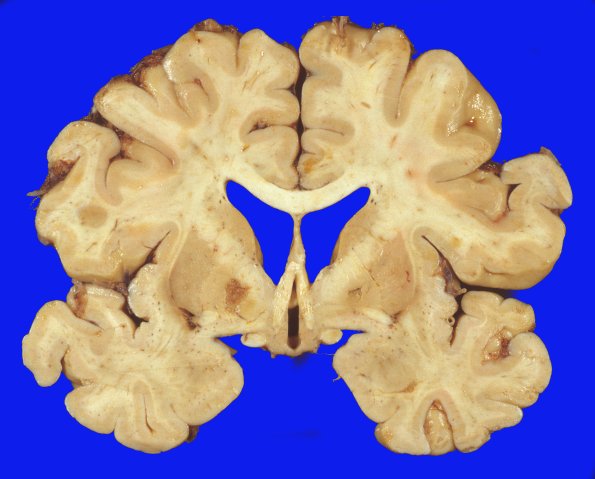 3A1 Parkinson's Dz (Case 3) Pallidotomy 1