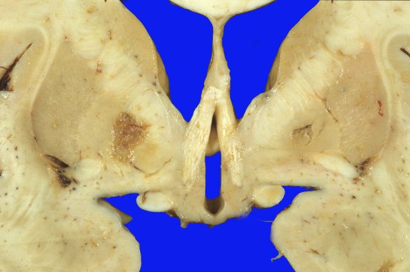 3A2 Parkinson's Dz (Case 3) & Pallidotomy 2