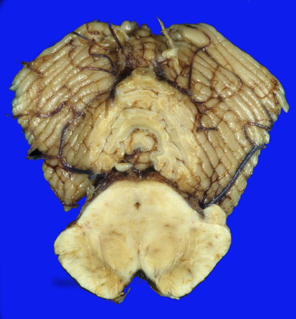 3A3 PD pallidotomy (Case 3) 4