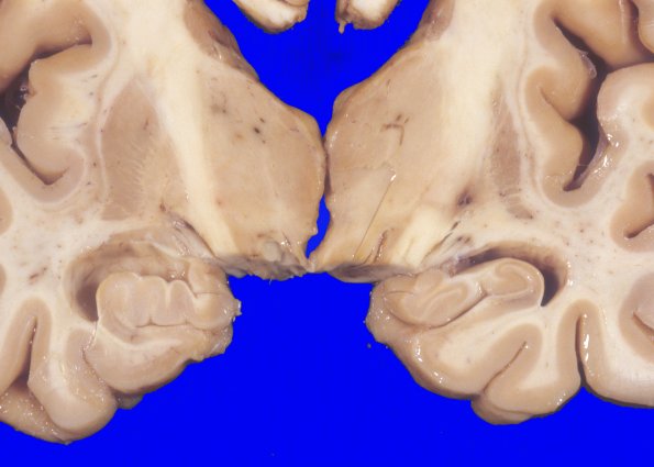 4A5 PD & STN, R Pallidotomy (Case 4) 2