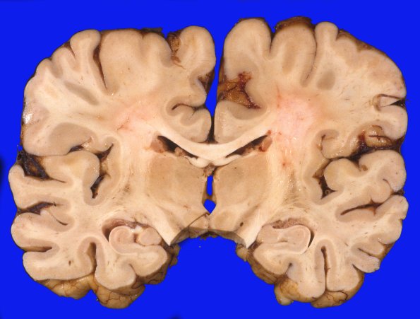 5A1 PD, subthalamic stimulator (Case 5) 2