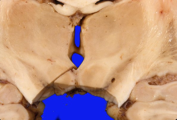 5A2 PD, subthalamic stimulator (Case 5)