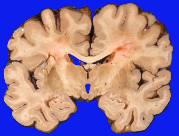 5A3 PD subthalamic stimulator (Case 5) 3