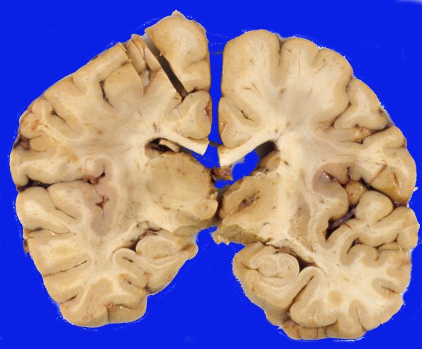 7A1 AD, DLBD & thalamotomy (Case 7) 1