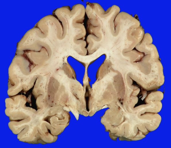 2A2 DLBD (Case 2) _4