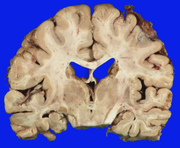 2A3 DLBD (Case 2) _5