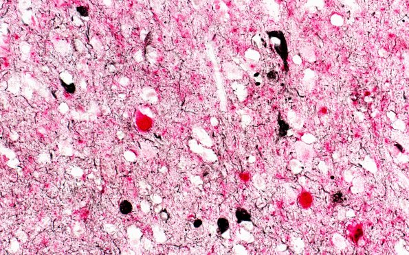 3B1 AD & DLBD (Case 3) (pSYNred PHFBlack)) 40X 1