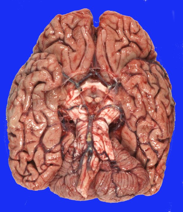 4A1 AD & PD (Case 4) Gross_1