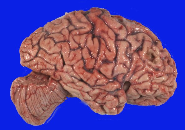 4A2 AD & PD (Case 4) Gross_2