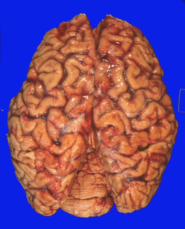 7A1 AD & PD & DLBD (Case 7) 2