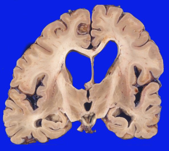 9A2 AD, PD, DLBD (Case 9) 2