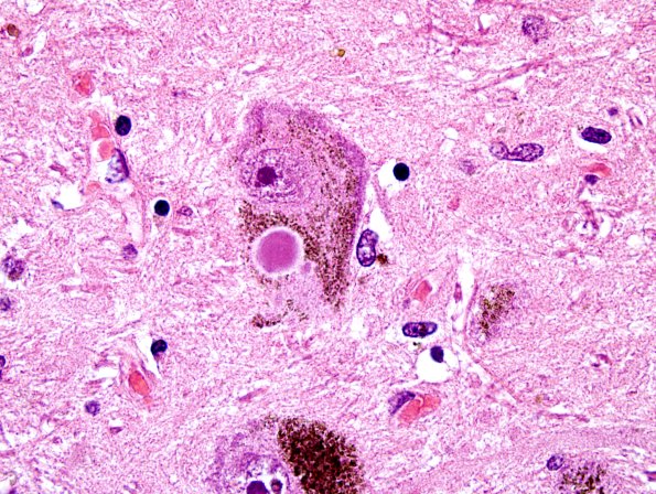 14 PD (Case 14) H&E 100X.jpg