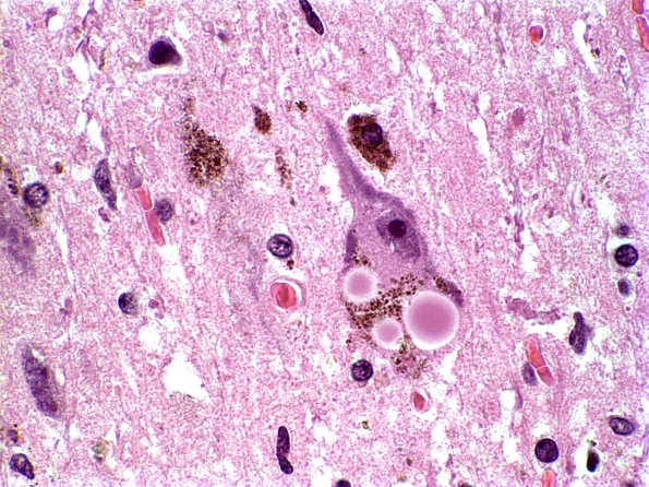 16 Parkinsons Dz (Case 16) H&E 1 Lewy body