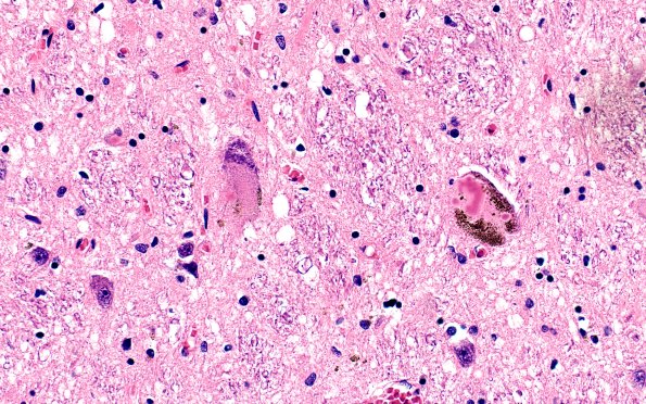 17A1 PD, Lewy body shape (Case 17) H&E 1