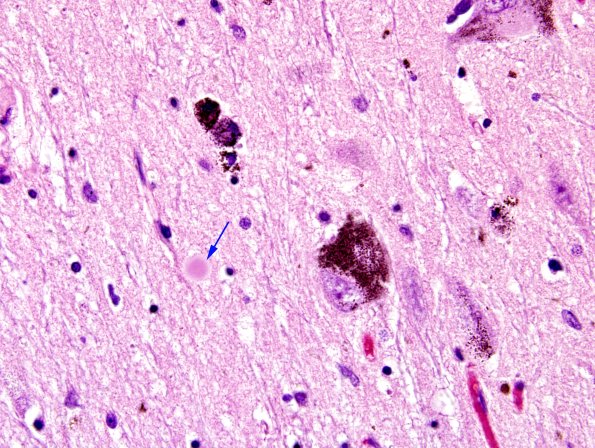 20 PD, extracellular Lewy body (Case 20) H&E 1 copy.jpg