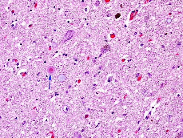 21 PD, extracellular Lewy body (Case 9) H&E 1 copy.jpg