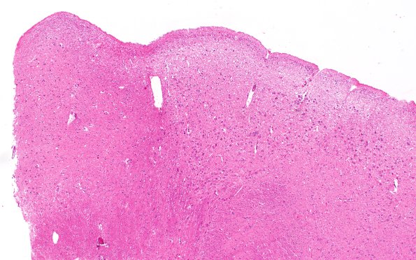 24A1 PD & Pure DLBD (Case 19) R8 H&E 4X