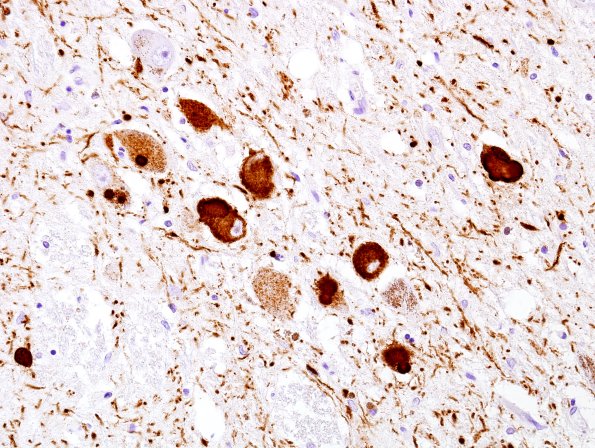 26A1 Parkinson's Dz (Case 26) SNigra pSYN 1.jpg