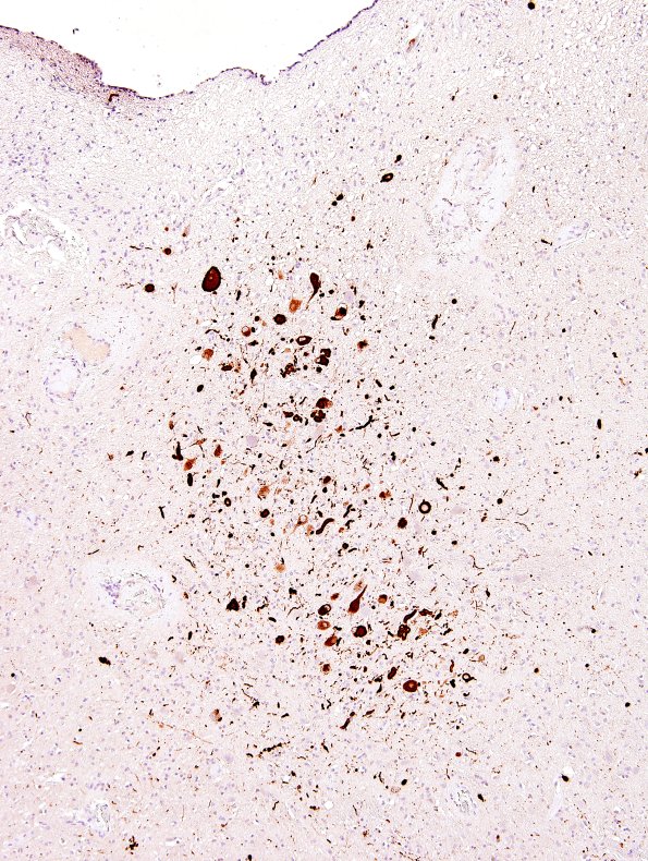 35A1 DLBD (Case 35) Dorsal Nucleus X pSYN 5.jpg