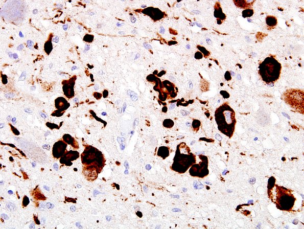 35A2 DLBD (Case 35) Dorsal Nucleus X pSYN 1.jpg