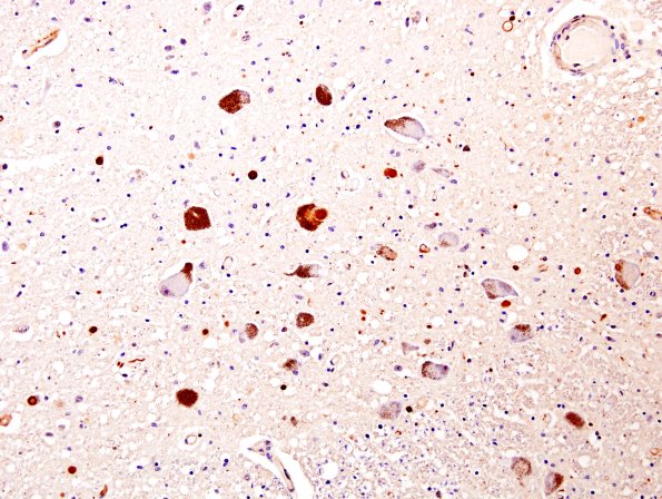 37A1 Parkinson's Disease (Case 37) Locus UBIQ Part 1A