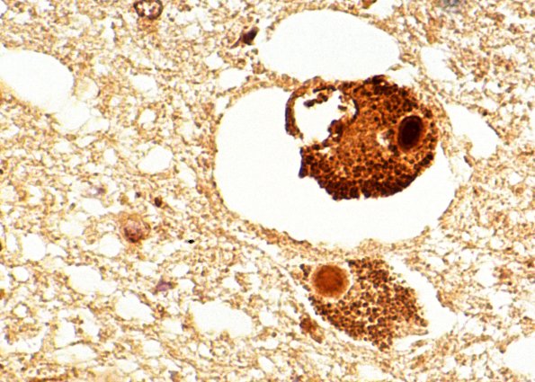 38A Parkinson's Dz (Case 16) ubiq