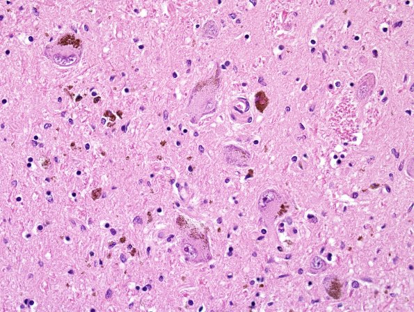 4 Parkinson Dz (Case 4) H&E 2.jpg