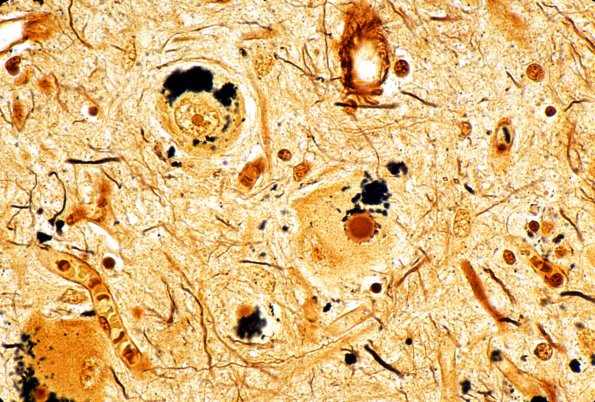 41A Parkinson's Dz (Case 41) Lewy Body Bielschowsky