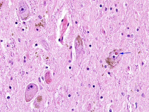 5 Parkinson's Dz (Case 5) SNigra H&E 5 copy