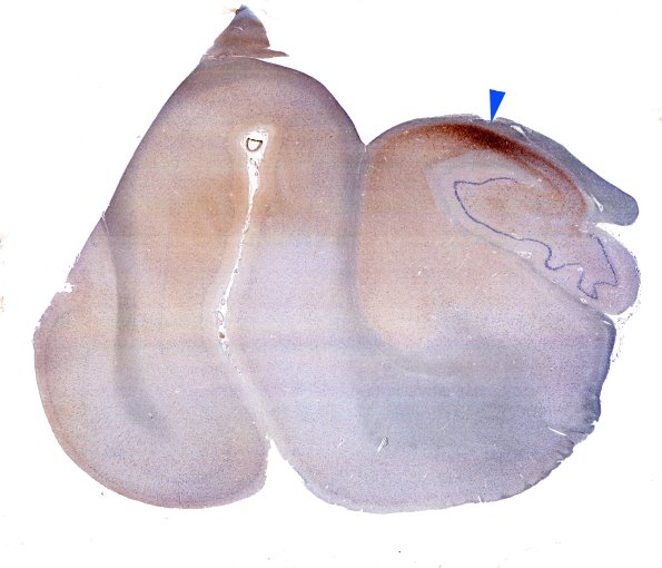 11A1 DLBD (Case 11) L5 pSYN whole mount copy