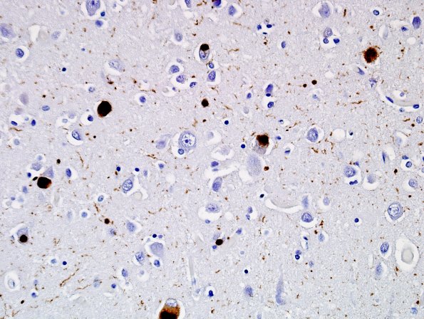 12A5 DLBD (Case 12) Cingulate L19 pSYN 4.jpg