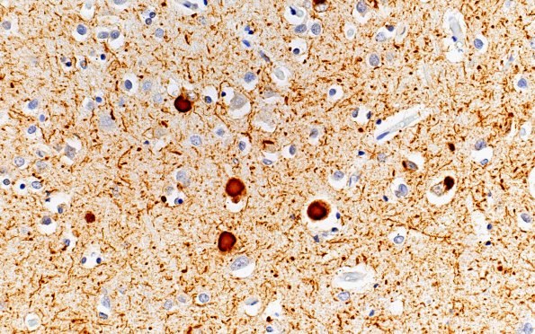 13A3 Lewy neurites (Case 13) pSYN 40X