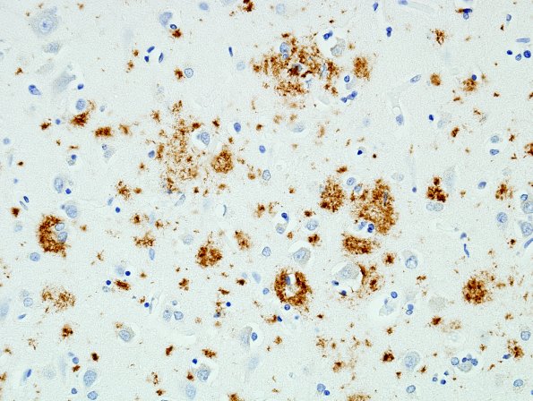 1C DLBD (Case 1) cortex BAmyloid 1