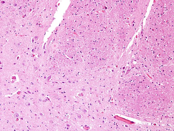 3A1 DLBD (Case 3) L8 Thalamus 20X match C H&E